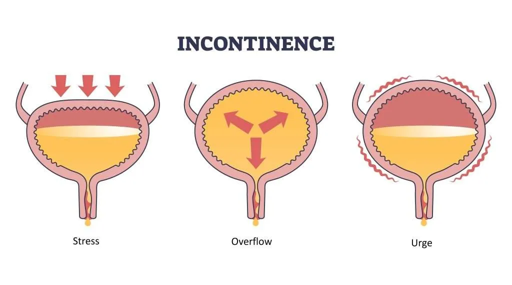 urinary incontinence North Vancouver