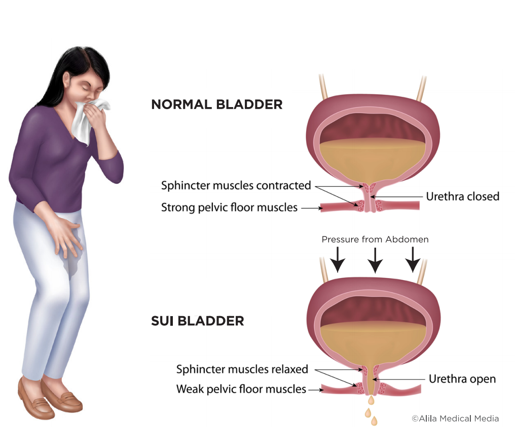 urinary incontinence physiotherapy North Vancouver